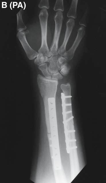 Vascularized Fibula Grafts 315 Fig. 2. (B) Patient was treated with resection, distal radius allograft reconstruction, and ulna-shortening osteotomy. have been similarly employed in the past.