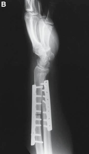 These complications often result in the need for wrist arthrodesis (43).