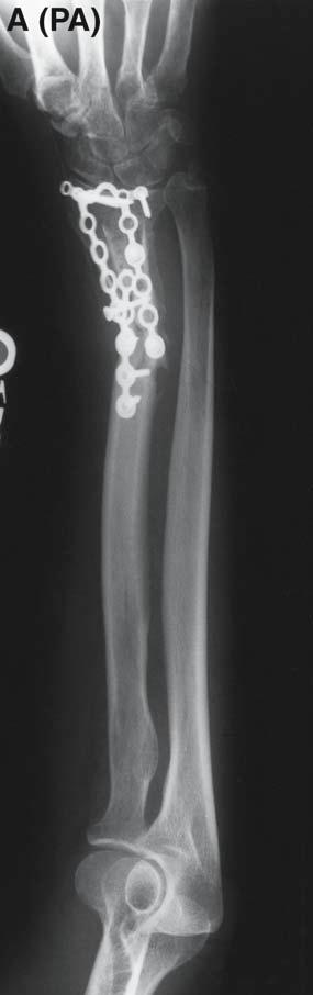 Vascularized Fibula Grafts 317 Fig. 3. Radiographs of the forearm of 46-yr-old female with an infected nonunion of the distal radius.