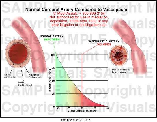 Tratamentul endovascular al vasospasmului Dilatarea arterială directă mecanică angioplastia