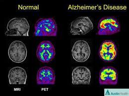 Today, the diagnosis of Alzheimer disease is made by using clinical criteria; however these criteria are not capable of diagnosing the disease in its pre-clinical stage, not