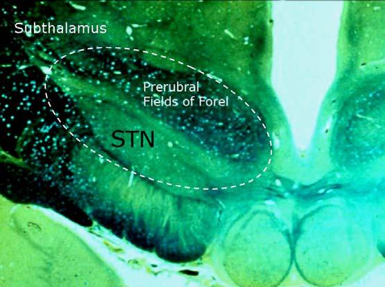SUBTHALAMIC NUCLEUS - Principal nucleus of subthalamus (ventral thalamus); its neurons are glutamatergic, excitatory (only excitatory neurons in the basal ganglia) The subthalamic nucleus is part