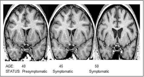RELATED DISORDERS HUNTINGTON DISEASE Decrease in the size of the striatal complex caused by loss of