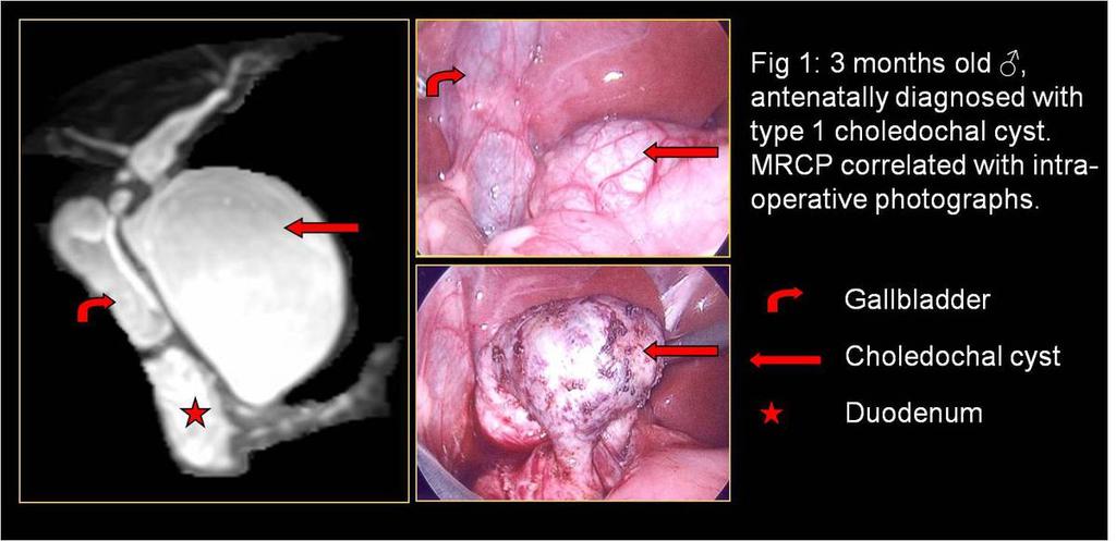 Imaging findings OR Procedure details Generally, the type Ic cysts are defined as fusiform dilatation of the common bile duct and common hepatic duct without involvement of the intrahepatic bile