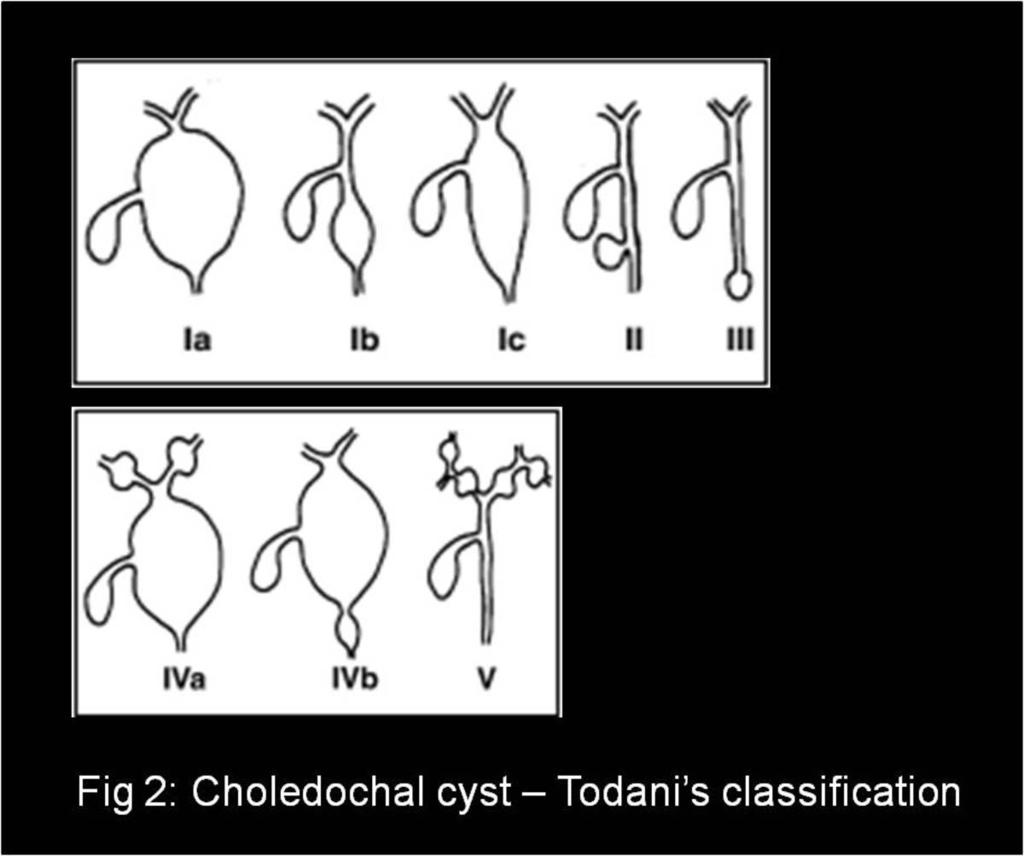Fig. 2: Choledochal cysts -