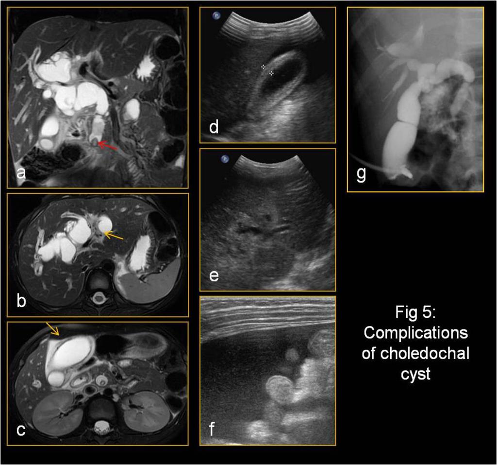 Fig. 4: 6 year old girl presented with abdominal pain. MRCP shows choledochal cyst with intrahepatic extention and minor strictures (red arrow) in the hepatic hilum.