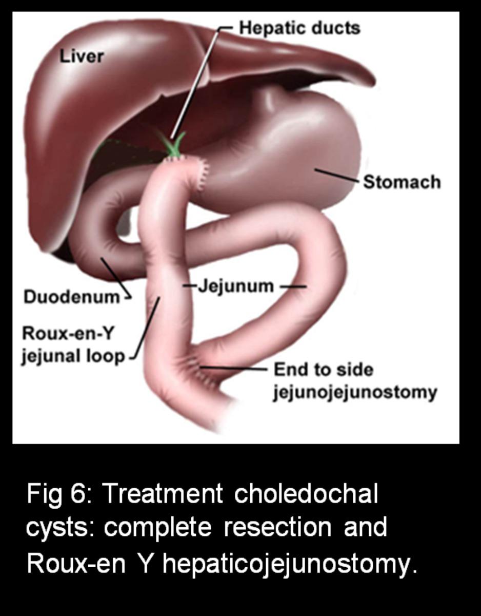 Fig. 6: Treatment of choledochal cysts:
