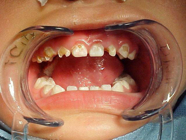 Early Childhood Caries Tooth decay in the primary teeth; often rapidly progressing Newly