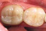 larger restorations such as crowns Adhesive luting Luting of Grandio blocs is always carried