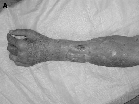 118 P.J. O Neill, C. Litts / Clin Plastic Surg 31 (2004) 113 119 Fig. 6. (A) Dorsal forearm defect after cancer excision and radiation therapy.