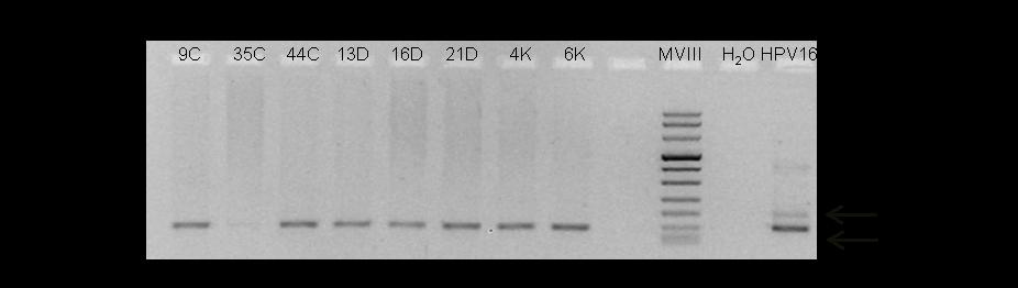 9C 4C 13D 16D 4K 6K 12K HPV16 MVIII H 2O 260bp 320bp 242bp Figure 13: PCR amplicons of β-globin gene of controls (C), dysplastic(d) and SCC (K) samples,ran in ethidium bromide stained agarose