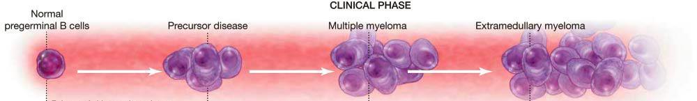 Multiple Myeloma: The Problem and the Opportunity Disease interception: MGUS and SMM MM premalignancy = 3.