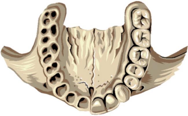 Form The ideal form of the upper jaw is a Gothic arch shape. The arch width tapers anteriorly and posteriorly with the widest part of the arch at the mesio-buccal cusp of the upper second molars.