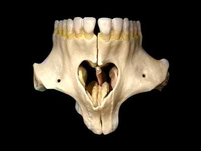 In most malocclusions the molars are mesially rotated. Figure 1.