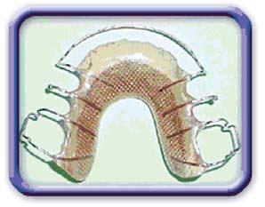 The Reinforced Removable Retainer (Triple R Retainer) is well tolerated, adaptable, and easy to fit and remove.