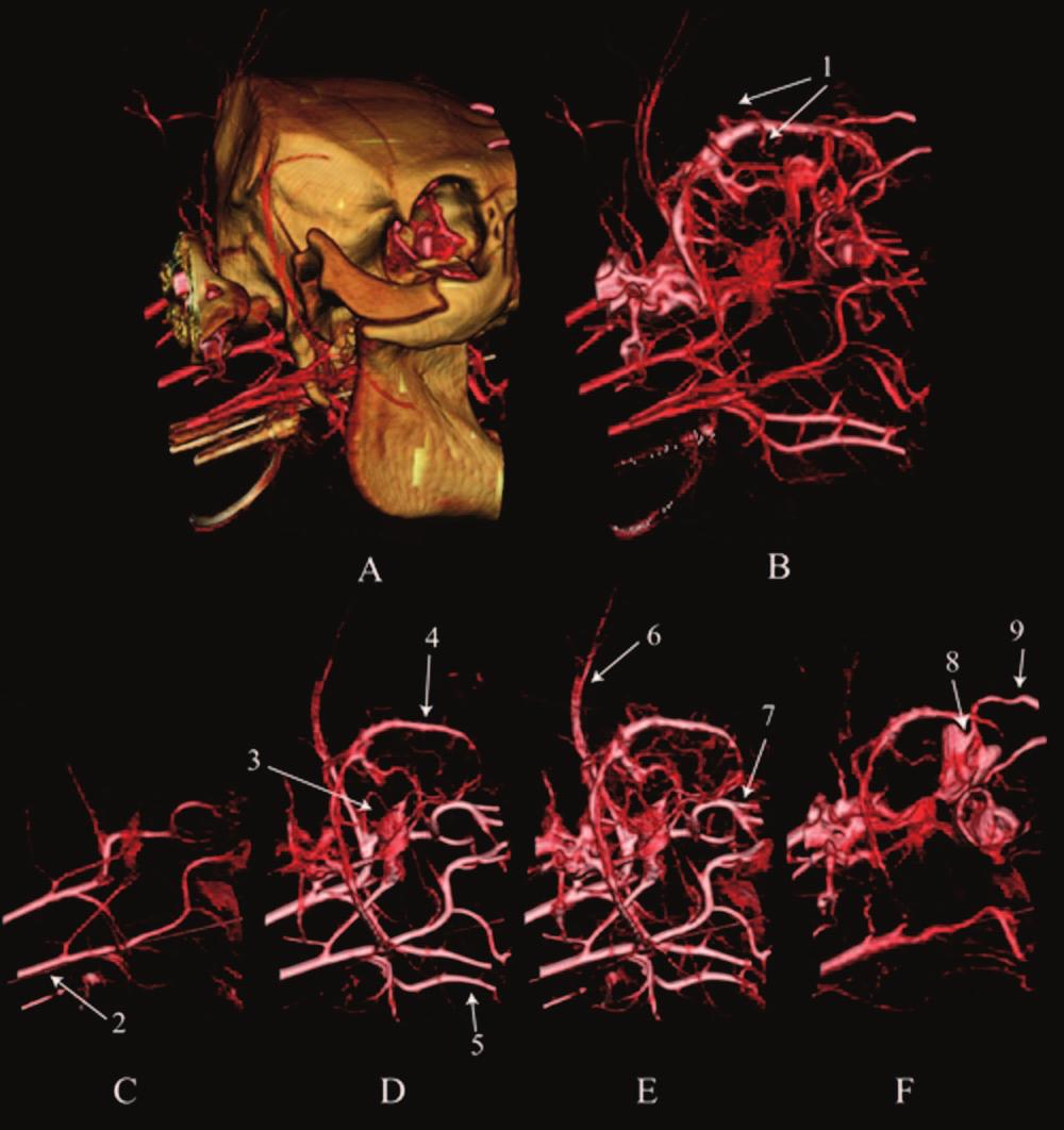 2538 MORI AJNR: 26, November/December 2005 FIG 1. 3D volume rendering beginning 15 seconds after the start of injection (A) with and (B) without cranial bones.