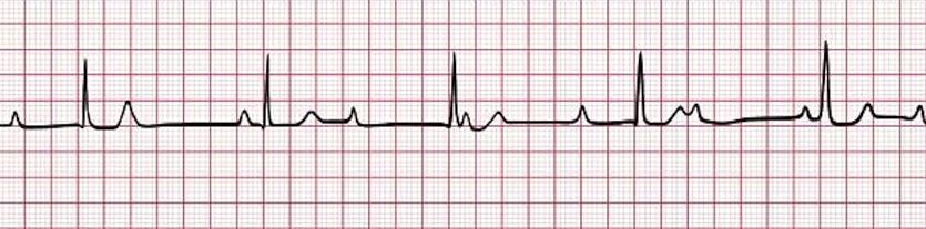 atria to the ventricles. Perfusing rhythm by junctional or ventricular escape rhythm. ECG 1.
