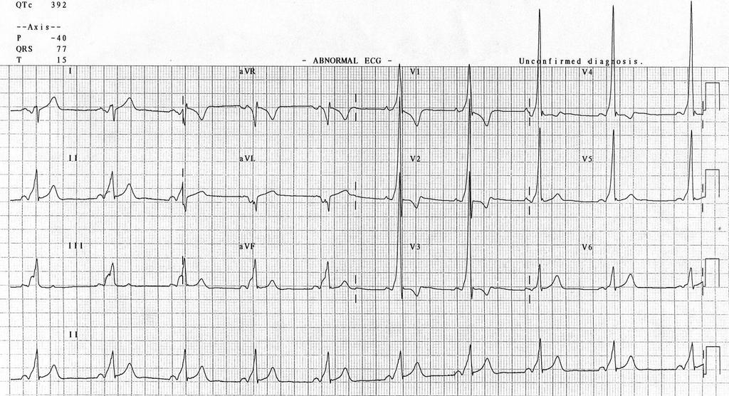 Atrioventricular reentry tachycardia-avrt Pathway outside the AV-node to the ventricles.