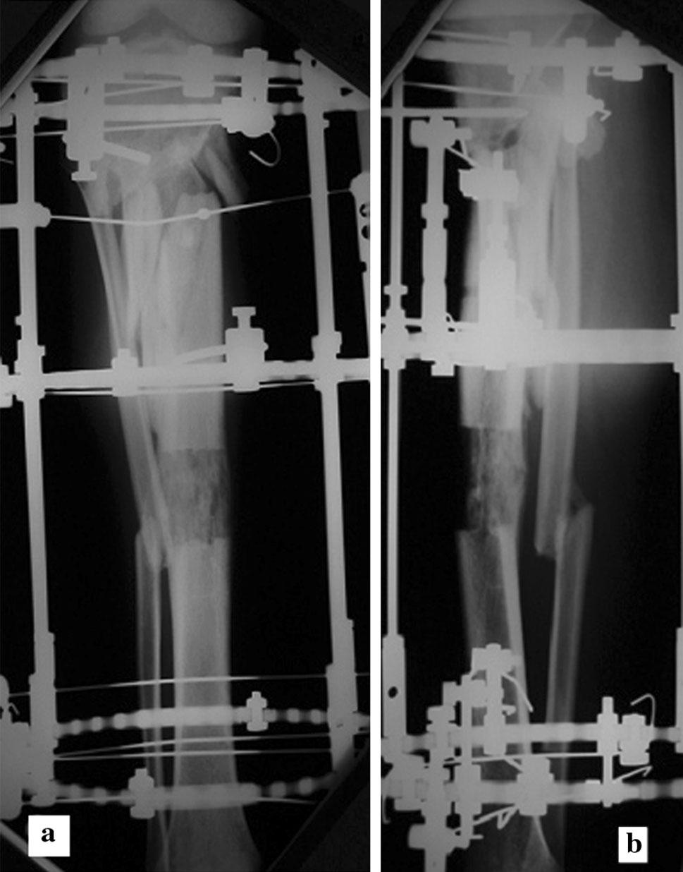 distal bone transport. The 13 proximal tibial fractures had distal to proximal bone transport. Corticotomies were done using predrilling technique.