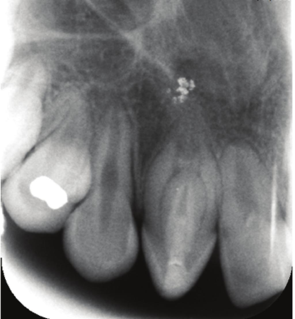 Case Reports in Dentistry 3 Figure 2: The one-year follow-up radiograph showing complete healing of the periapical lesion. gingiva was swollen.