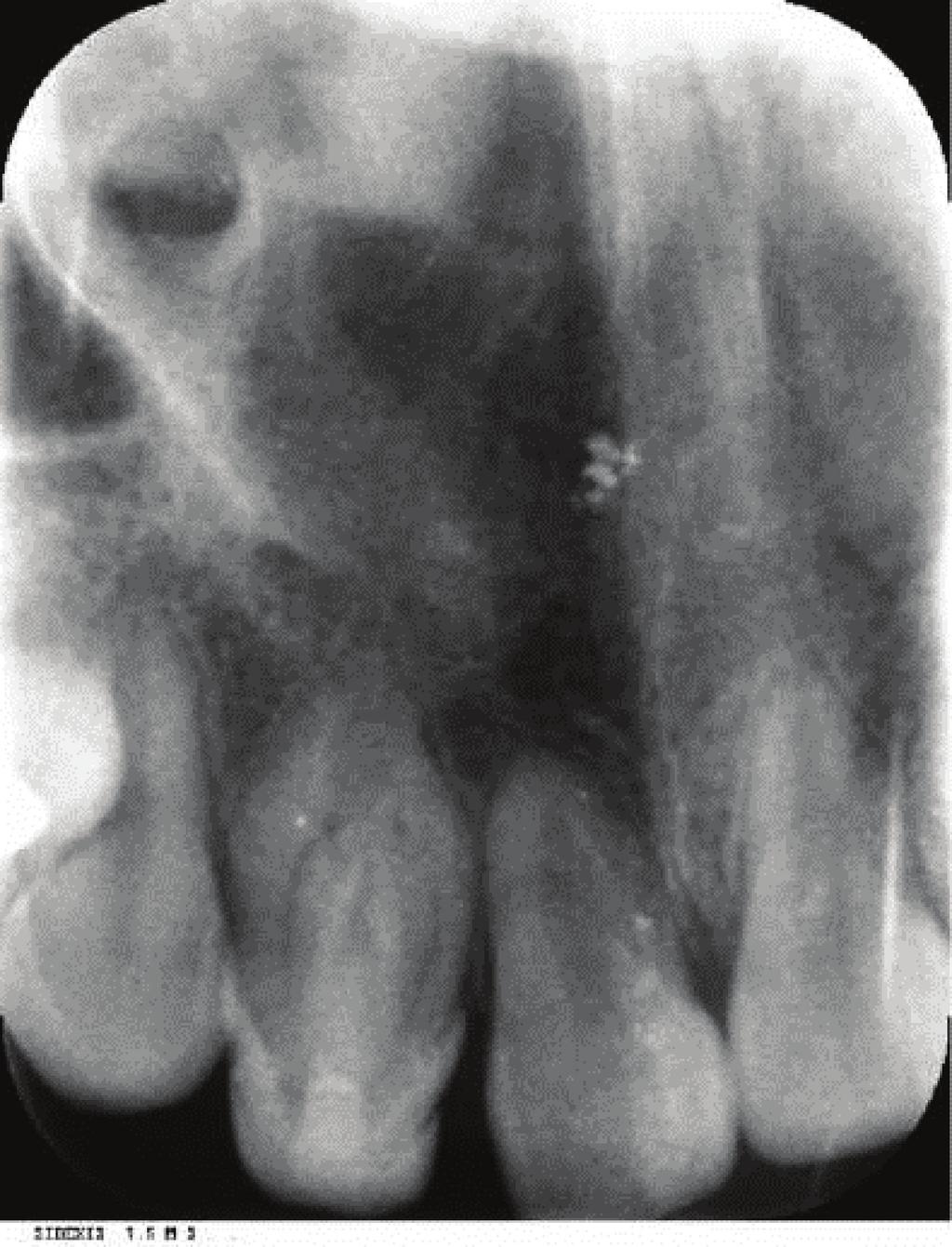 One month after the antibiotic treatment, the tooth was asymptomatic. In the next phase of the treatment, the regeneration protocol was performed.