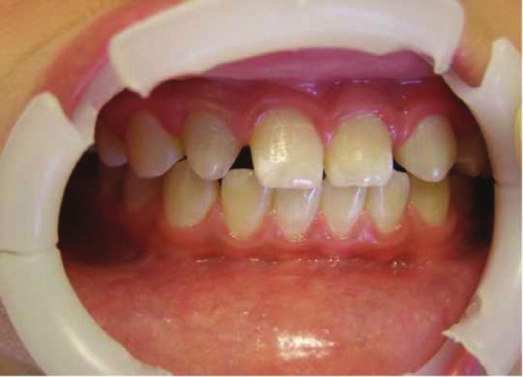4 Case Reports in Dentistry Figure 4: Clinical photography of maxillary right lateral incisor at the twenty-month follow-up appointment. long-term retention.