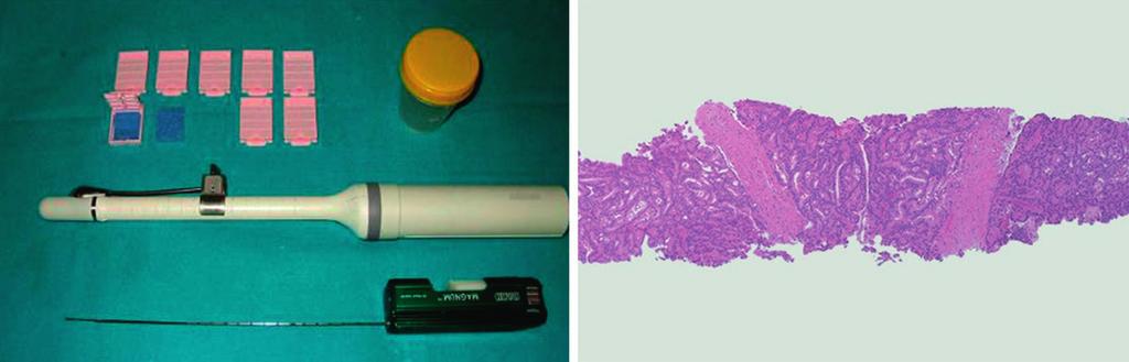 46 Ružić B., Knežević M. SLIKA 1. Transrektalna UZ sonda s bioptičkim pištoljem (lijevo) i bioptat za PHD (desno) slučajeva karcinoma prostate radi o nasljednom obliku.