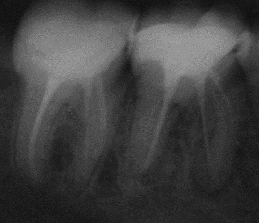 present, the MM canal is found in the developmental groove between the mesiobuccal and the mesiolingual canals.