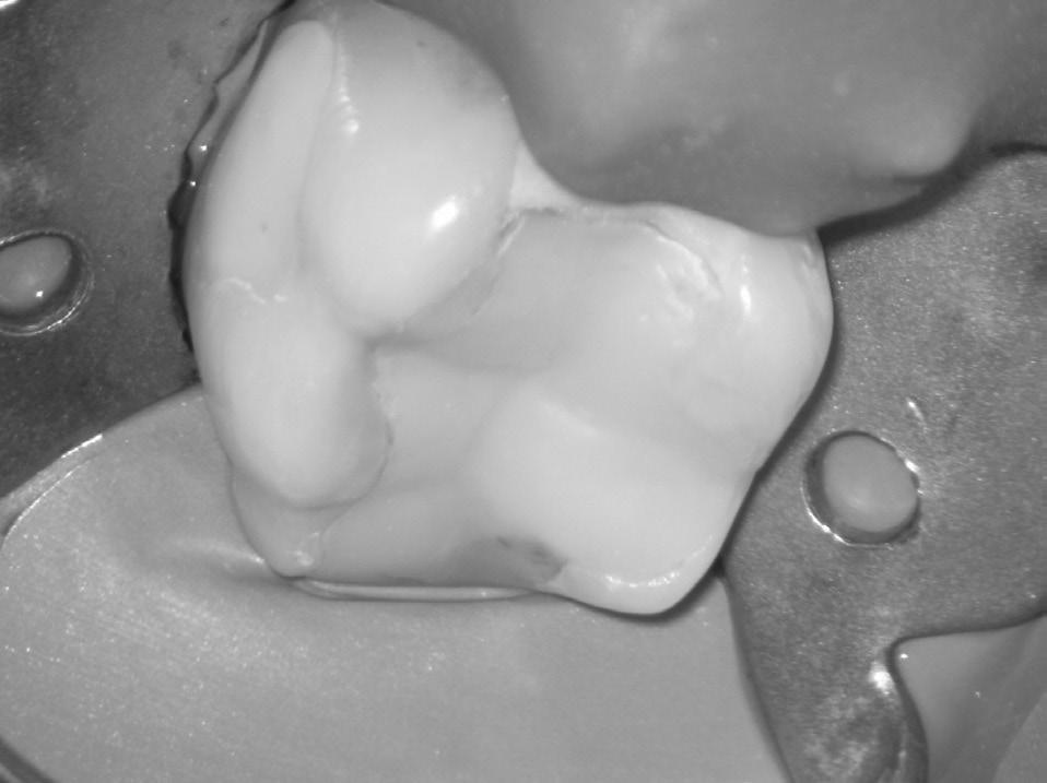 This case report describes the orthograde endodontic retreatment performed on a first mandibular molar with five root canals, two distals and three mesials, situated in two roots, diagnosed with