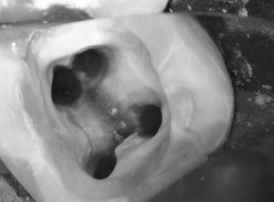 Figure 3. The aspect after removing the former coronal restoration and refining the access cavity. The pulp chamber and the root canals are full of filling materials and debris.