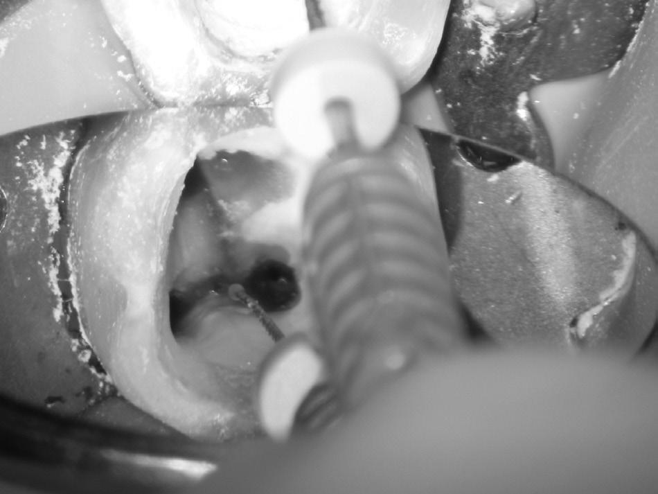 These nickel-titanium rotary instruments were used in a crown-down manner in combination with a torque-controlled engine (X-Smart TM Endodontic Motor, Dentsply, UK) at 500 rpm, according to the