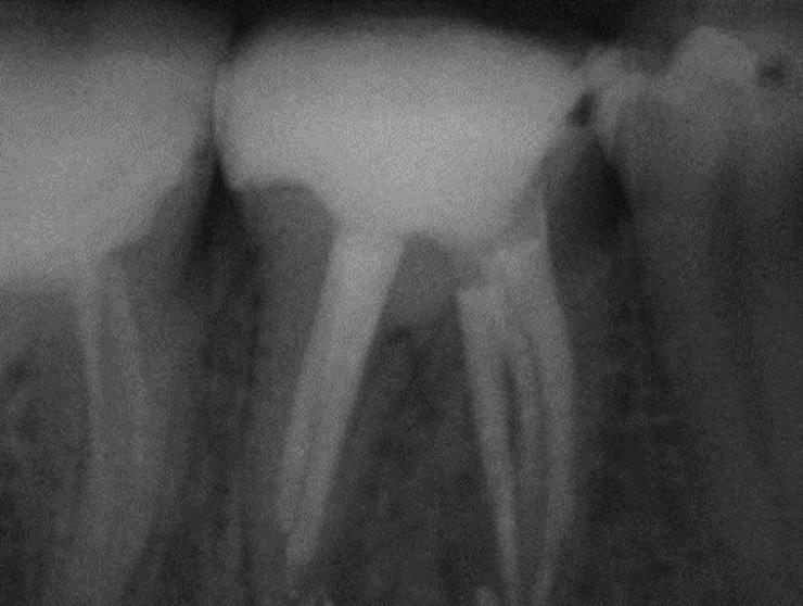 improper cleaning-shaping-obturation will lead to endodontic failure, which sooner or later will consist in an apical periodontitis.