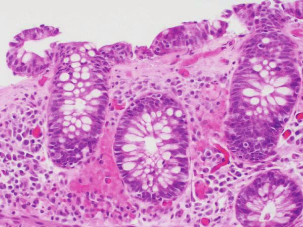 2 Case Reports in Gastrointestinal Medicine Figure 1: Colonic mucosa with thickened subsurface collagen deposition ( hematoxylin-eosin;
