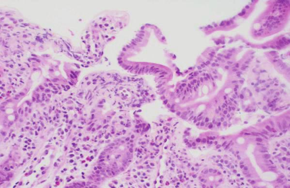 Case Reports in Gastrointestinal Medicine 3 Figure 3: Duodenal mucosa with only scant foci of subsurface collagen deposition not diagnostic of collagenous duodenitis ( hematoxylineosin; Masson