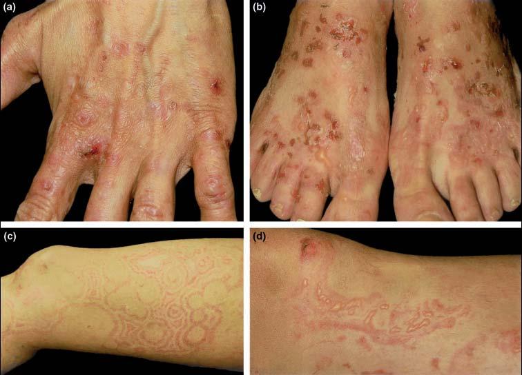 Figure 1. Blisters, erosions, scarring and milia formation on (a) patient s left hand and (b) feet.