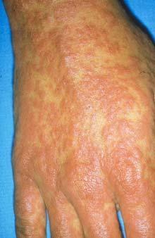 Case 2 50 year old male from the Philippines recently diagnosed with smear+ TB Started on NH/RF/PZA/EMB Diffuse rash developed by day 7 and all drugs held.