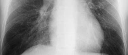 consistent with TB Clinical or radiographic response to anti TB therapy in the absence of another diagnosis Positive