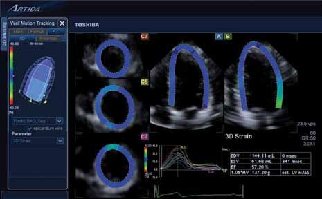 Three-dimensional Wall Motion Tracking: A Novel Echocardiographic Method for the Assessment of Ventricular Volumes, Strain and Dyssynchrony Jeffrey C. Hill, BS, RDCS, FASE Jennifer L.