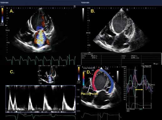 Figure 1: These images were taken from the study of a patient with CHF and severe mitral regurgitation in the apical four chamber view (A); severely reduced LV function (EF = 17.