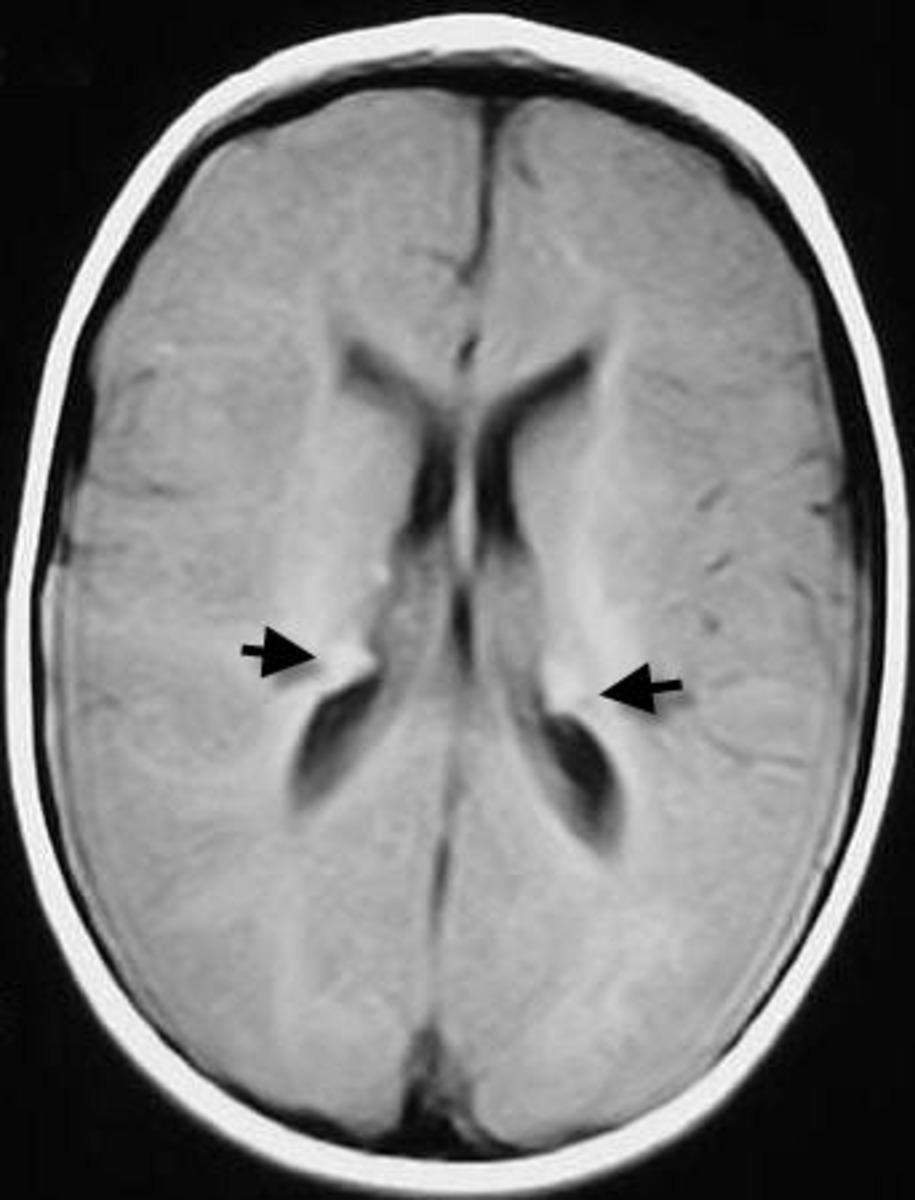 Fig 3: MRI on axial T1-weighted sequences of a 5-year-old male patient, who presents with