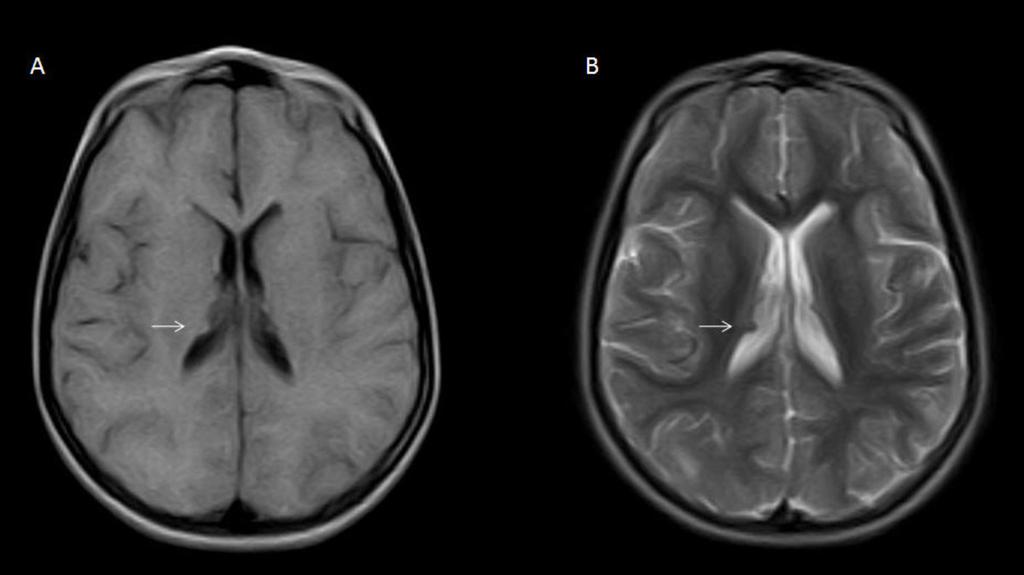 Fig 4: MRI on axial T1-weighted sequences (A) and