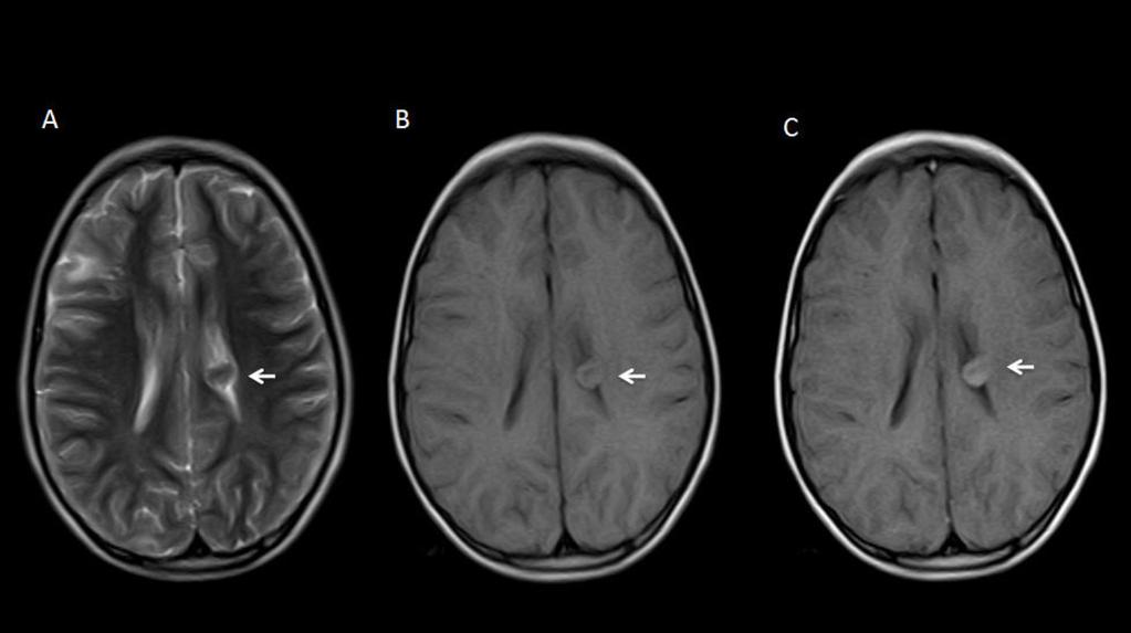 Fig 5: MRI on axial T1 without contrast agent (A) and with gadolinium (B) of a 2-yearold male patient, who presents with