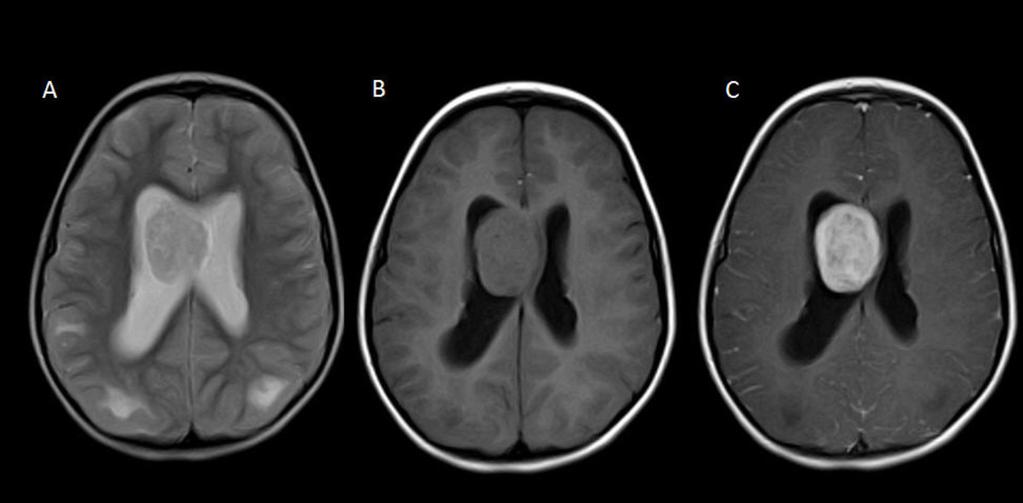 identified, located on the wall of the left lateral ventricle (arrows), hypointense on T2 (A), isointense on T1 (B) and