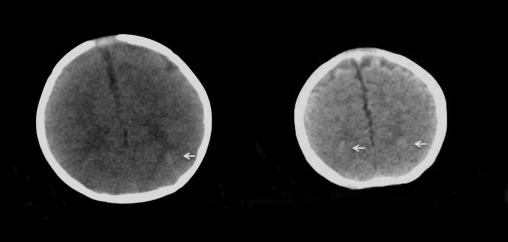 Fig 7: On this MRI of a 7-year-old female patient, an intraventricular, ovoid, voluminous mass is observed, which produces hydrocephaly as it occludes Monro's holes; this mass is hyperintense on T2