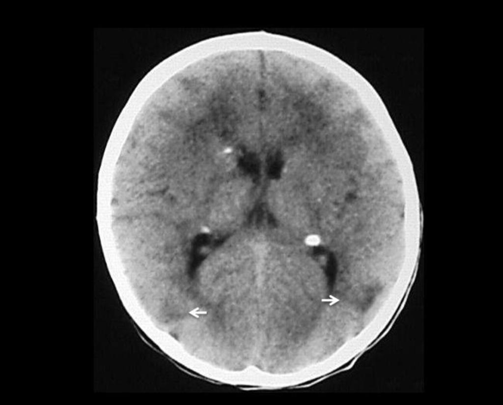 Fig 9: CT scan of a 1-year-old male patient, which shows cortical
