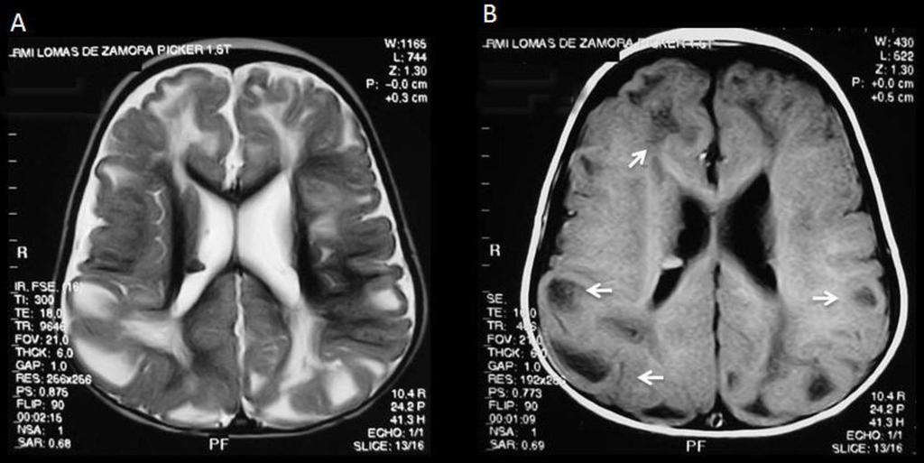 Fig 10: MRI of a 2-year-old female patient, who presents with multiple
