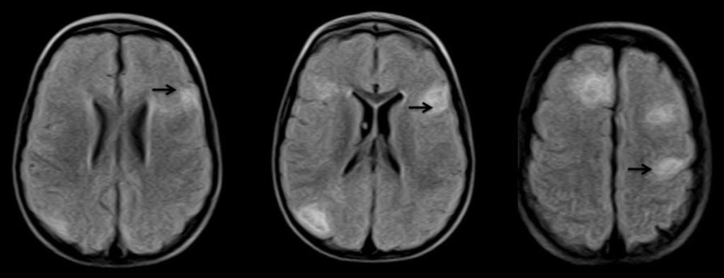 cortical tubers (arrows) Fig 11: MRI of a 2-year-old male patient which