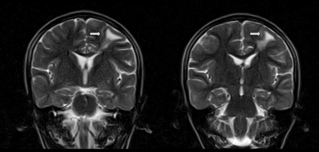 Fig 12: MRI of a 7-year-old female patient On the coronal T2-weighted sequence a hyperintense lesion is