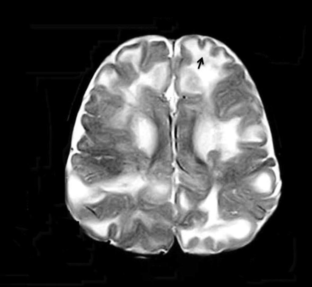 Fig 13: MRI of a 2-year-old male patient A lesion in the subcortical white matter is identified, hyperintense on