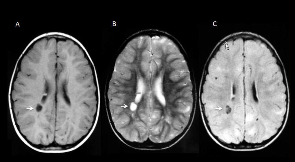 Fig 14: MRI of an 8-year-old female patient, which presents a hyperintense image on T2 (A) and hypointense on T1 and FLAIR (B